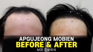 M자 모발이식 5100모 경과영상 I 압구정모비앙의원_경과모음