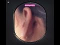 Behind the ear??😳#blackheadremoval #ExtractionNationSoSatisfying #fyp...