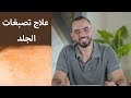 علاج تصبغات الجلد