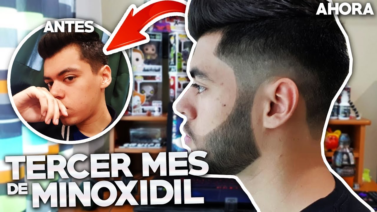 TERCER MES USANDO MINOXIDIL | TRATAMIENTO PARA LA BARBA