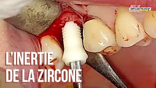 Implantologie Archives - Page 3 sur 14 - Dentalespace
