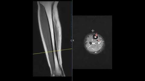Shin splints from running in high school track