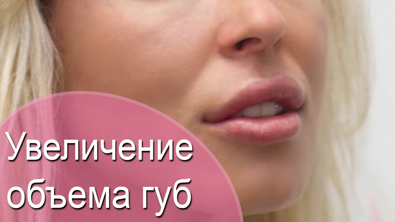 Препараты для увеличения губ на основе гиалуроновой кислоты Препараты для увеличения губ на основе гиалуроновой кислоты