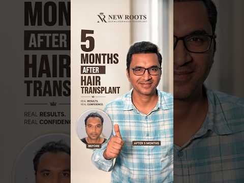 Grade 3 Baldness Hair Transplant in Lucknow | 5 Months Result #hairtransplant #lucknow #shorts