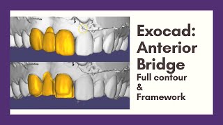 Exocad: Anterior Bridge (Full contour & Framework/Coping)