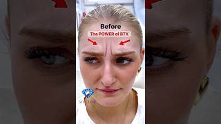 Before and After  - Glabella area, also known as frown lines.