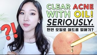 CLEAR ACNE WITH OIL! • BEST Oils for Acne Prone Skin