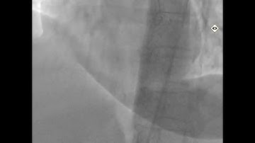 Retrograde approach to RCA  CTO