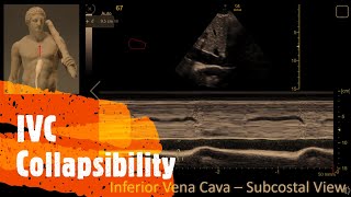 Estimate the Right Atrial Pressure using the IVC. Perioperative & Critical Care ECHO/ POCUS