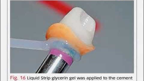 Bench Mastery: Using IPS e.max Press Abutment Solutions for Better Implant Restorations