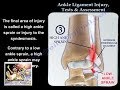 Ankle Ligament Injury, evaluation and tests - Everything You Need To Know - Dr. Nabil Ebraheim