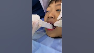 Cùng đến với công nghệ quét dấu hàm iTero của Hùng Cường #trongrangimplant #nhakhoahungcuong