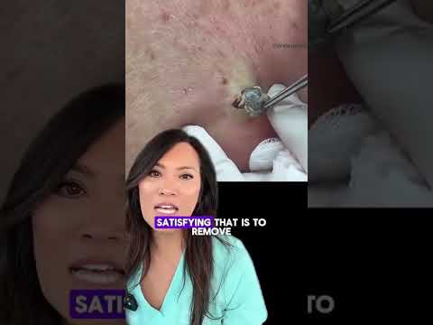 We thought these were cysts at first, but they ended up being Dilated Pores of Winer...