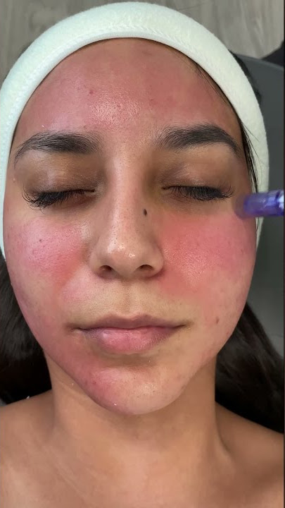 Microneedling 😮😬💉 | Evoclinic