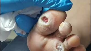 Pedicure Tutorial: How to treat plantar wart. Plantar wart removal. Two deep holes on the foot.