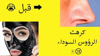 أزالة الرؤوس السوداء من الأنف | خلطة لأزالة الرؤوس السوداء من تجربتي بعد عناء طويل | 