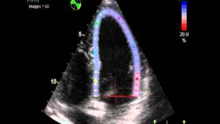 ? IS EJECTION FRACTION NORMAL 2 ?  STRAIN VALUE / ECHOCARDIOGRAPHY cardiac ultrasound