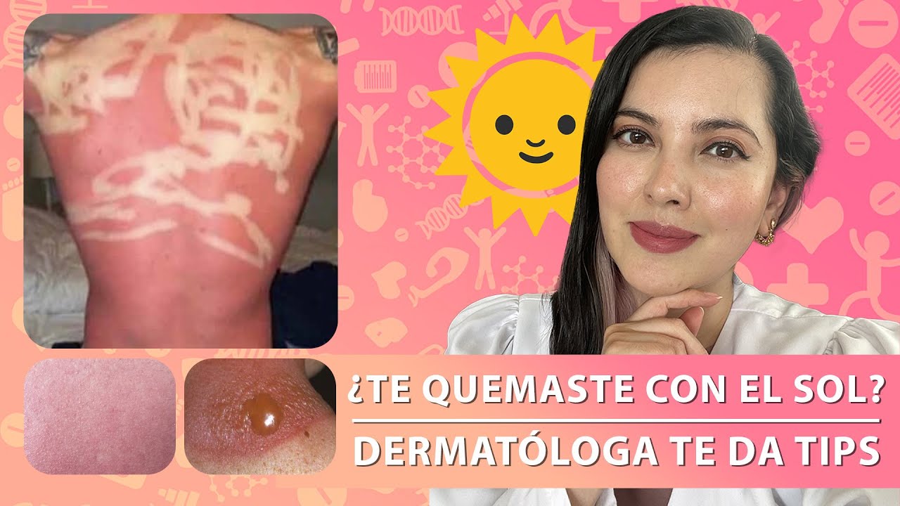 ☀️🥲¿Te QUEMASTE con el SOL? Cuidados básicos/DermaTips👩🏻‍⚕️