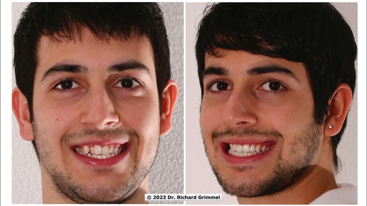 Aligner Schneeketten Lingualtechnik Kieferorthopädie bei Erwachsenen 400 Fälle vorher