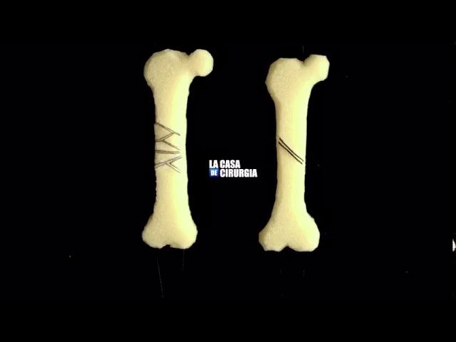 Strain Theory in Bone Fracture
