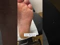 Callus and corn removal by podiatrist  latest techniques with ergonx and docpods