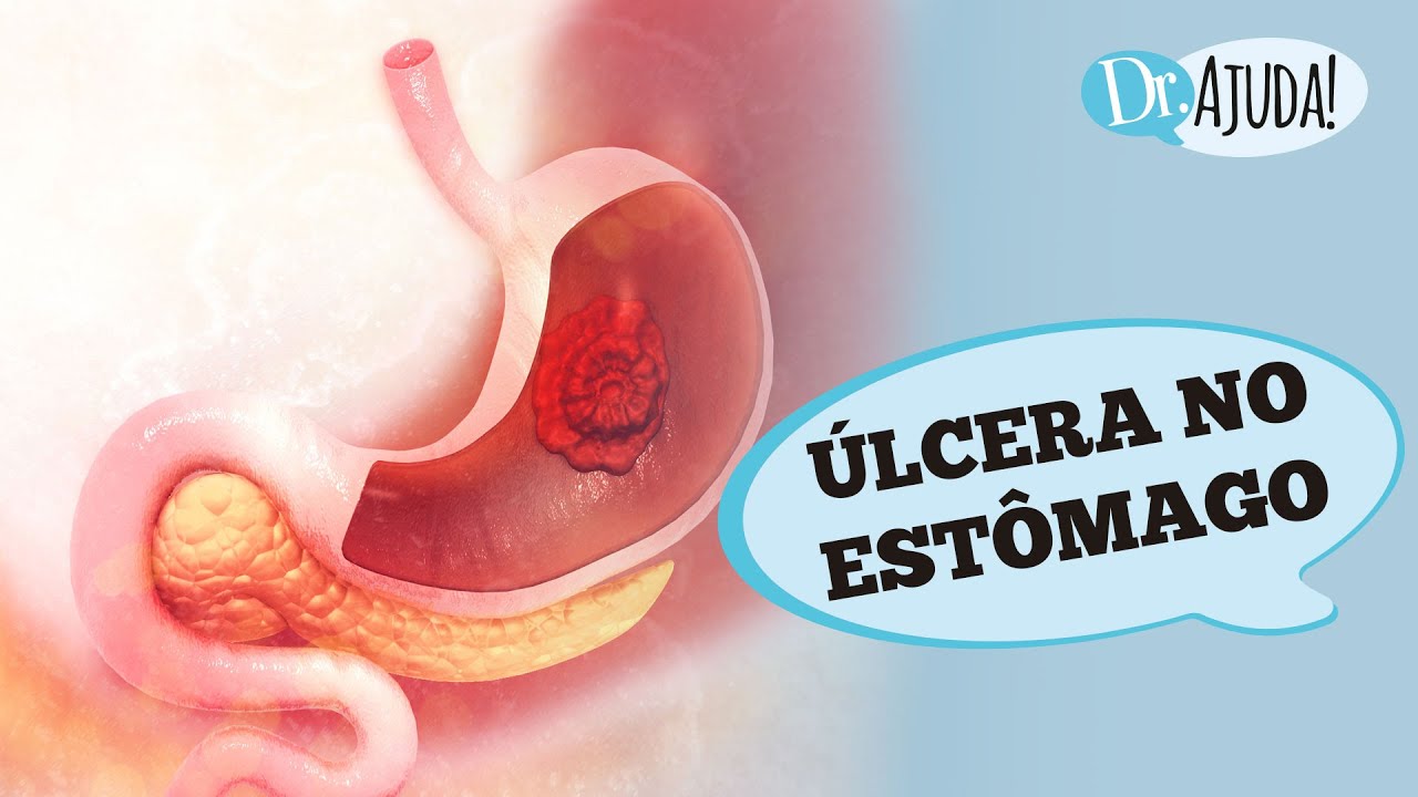 ÚLCERA NO ESTÔMAGO E DUODENO: SINTOMAS, DIAGNÓSTICO, TRATAMENTO E ...