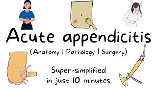 Acute appendicitis surgery (Anatomy, pathology, surgery super-simplified) | Med Vids Made Simple