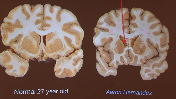 Researcher says Hernandez's brain was severely imp...