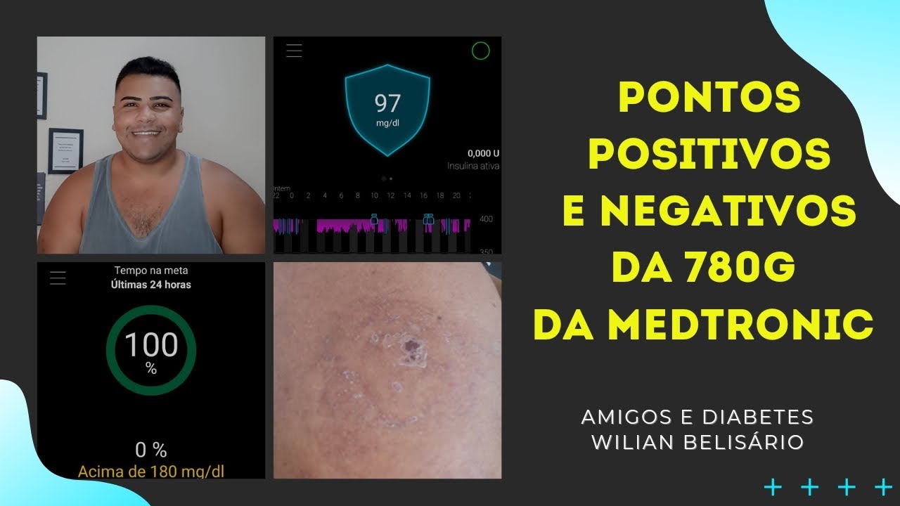 1 MÊS USANDO BOMBA DE INSULINA 780G #MEDTRONIC | AMIGOS E DIABETES
