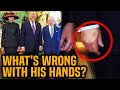 Trump’s hands suddenly COMPLETELY ROTTEN