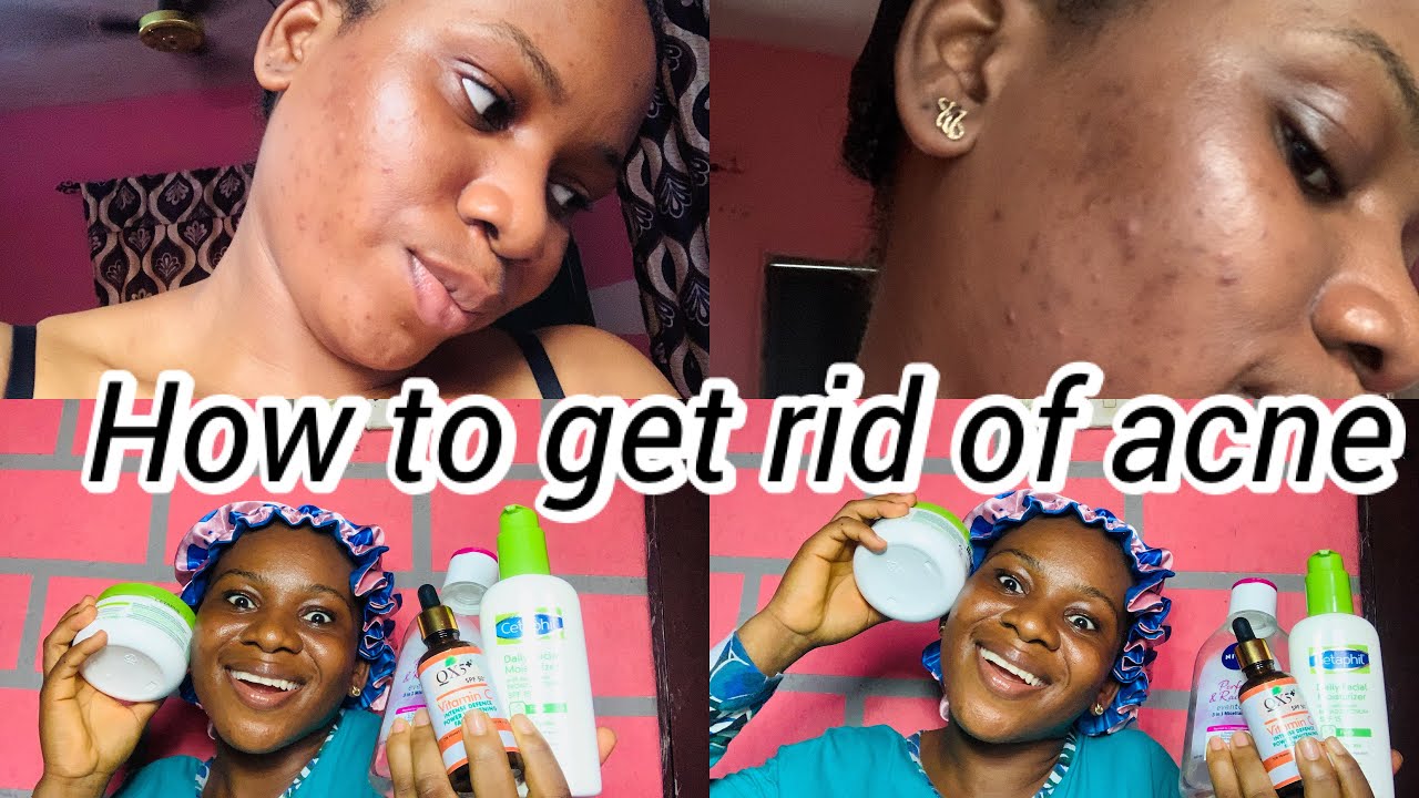 HOW TO GET RID OF ACNE WITHIN 5DAYS | MY DAILY SKINCARE ROUTINE - YouTube