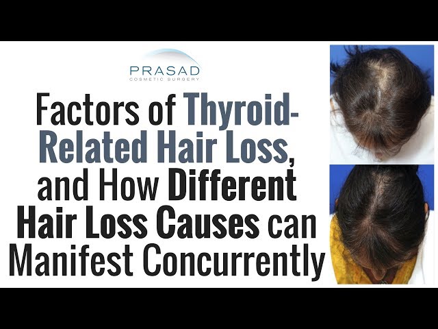 Thyroid Hair Loss