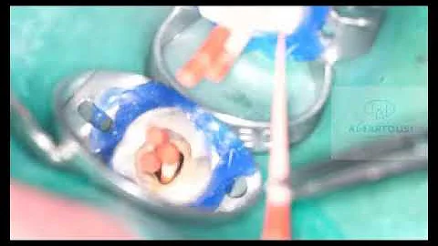 Eddy, BC Sealer, Reciproc Blue