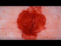 おへその中で固まった強力接着剤をピンセットで無理やり引き剥がす動画 Peeling Super Glue Out Of A Belly Button With Tweezers おへその中で固まった強力接着剤をピンセットで無理やり引き剥がす動画 Peeling Super Glue Out Of A Belly Button With Tweezers