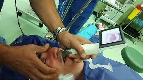 Tracheal Intubation with HugeMed VL3R Reusable Video Laryngoscope