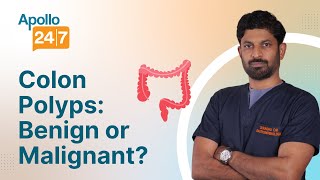 Are Colon Polyps Cancerous? | Dr. Raghu D K