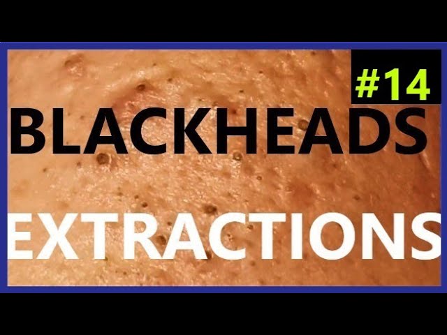 BLACKHEADS EXTRACTIONS on Happy #14