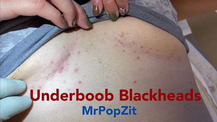 Underboob (infra-mammary) blackhead extractions! C...