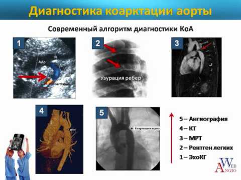 Video: Koorktacija Aorte: Vzroki, Simptomi In Diagnoza