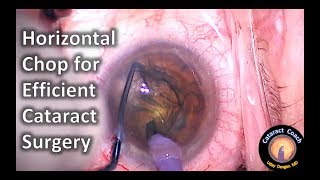Horizontal Phaco Chop Technique for Efficient and Safe Cataract Surgery