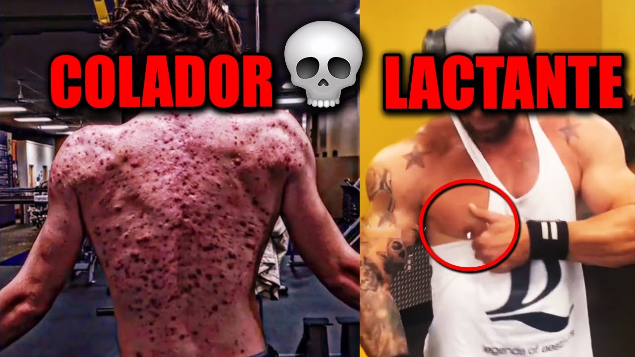 HABLEMOS DE ACNÉ Y LACTANCIA EN CHUZADOS.