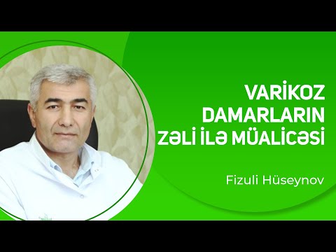 Varikoz damarların Zəli ilə müalicəsi | Fizuli Hüseynov