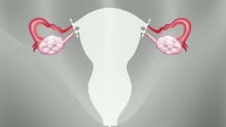 First womb transplant in UK completed by surgeons   BBC News