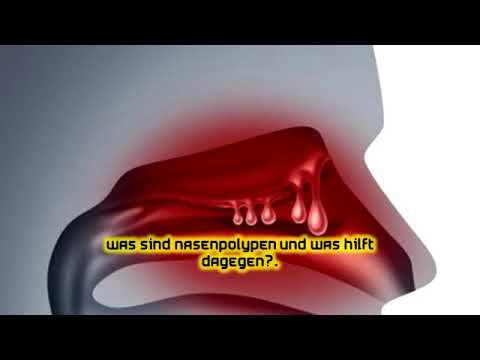 Video: Natürliche Behandlung Der Nasenpolypen: 12 Behandlungen Zu Hause