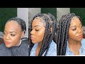 You DON'T need a hairline to get box braids! Alopecia approved ✅ (detailed video)