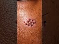 Satisfying Cheek Blackhead Removal ASMR | Macro Detail #asmr #satisfying #blackheadcaique #skincare