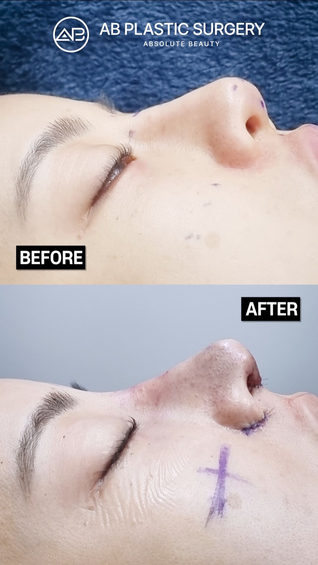 Dream Nose Achieved Perfect Rhinoplasty Results #shorts