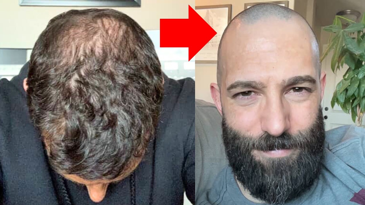 THIS Mans Balding Story Could Save You YEARS Of Suffering