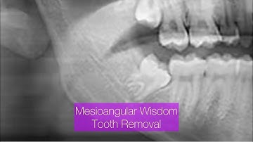 Mesioangular Wisdom Tooth Removal Step by Step @drwahan @DrWahanExperiment