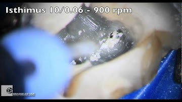 ScoutRaCe Obliterated Canal (Clinical)